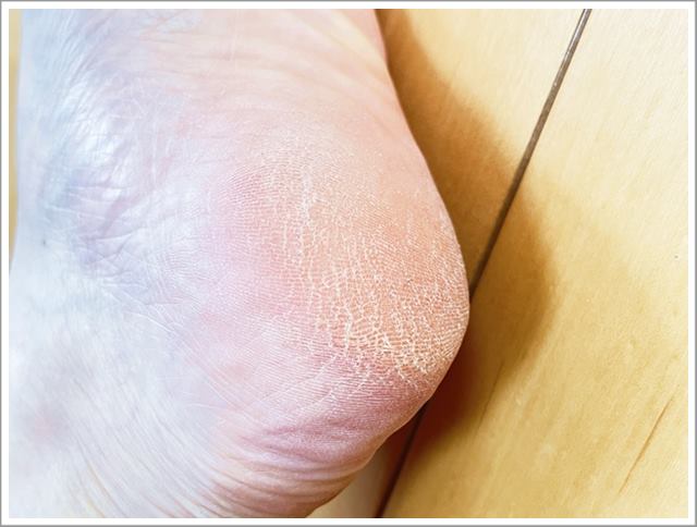 カカトのお手入れ前